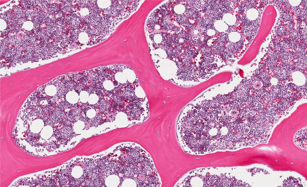 Bone marrow cells and multiple myeloma.